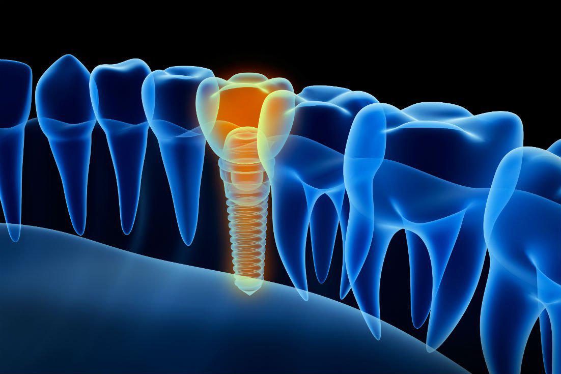 Dental Implants Lyndhurst, OH